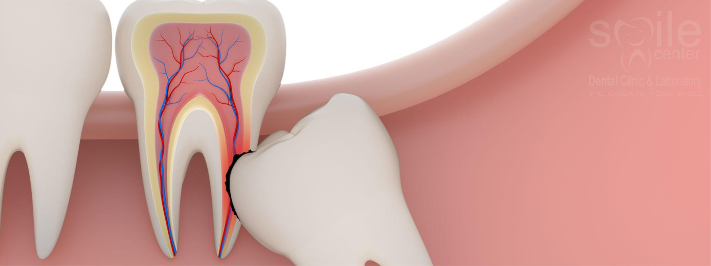 Gömülü Diş Tedavisi