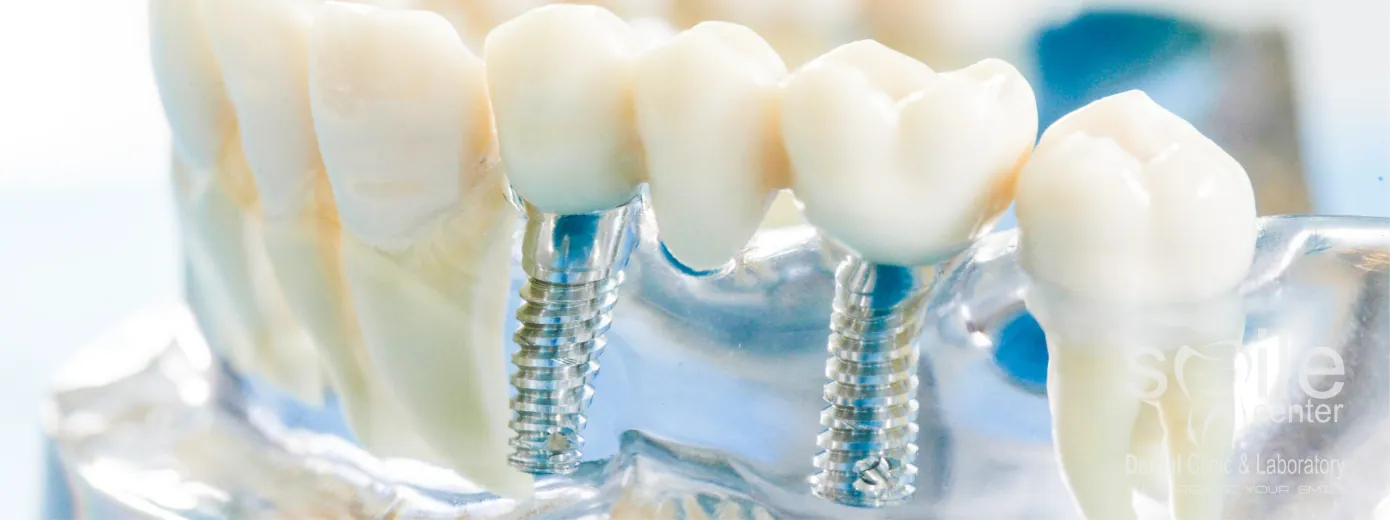 İmplant Tedavileri