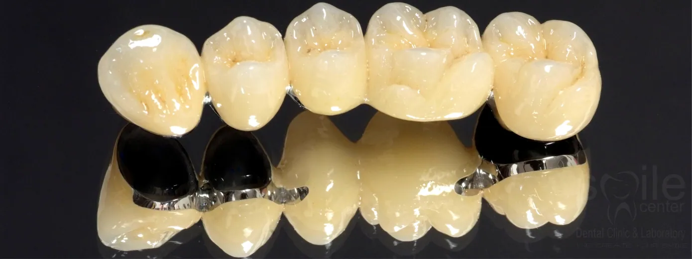 Porselen Uygulamaları ve Tedavileri