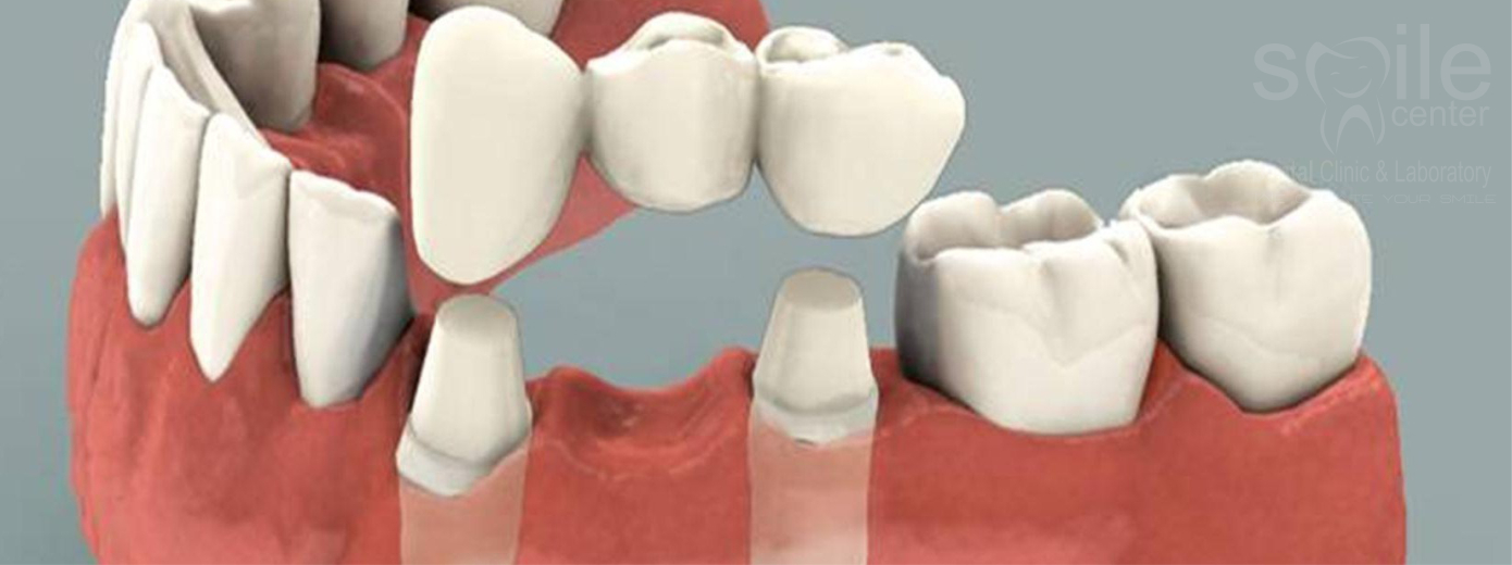 Köprü Uygulamaları ve Tedavileri